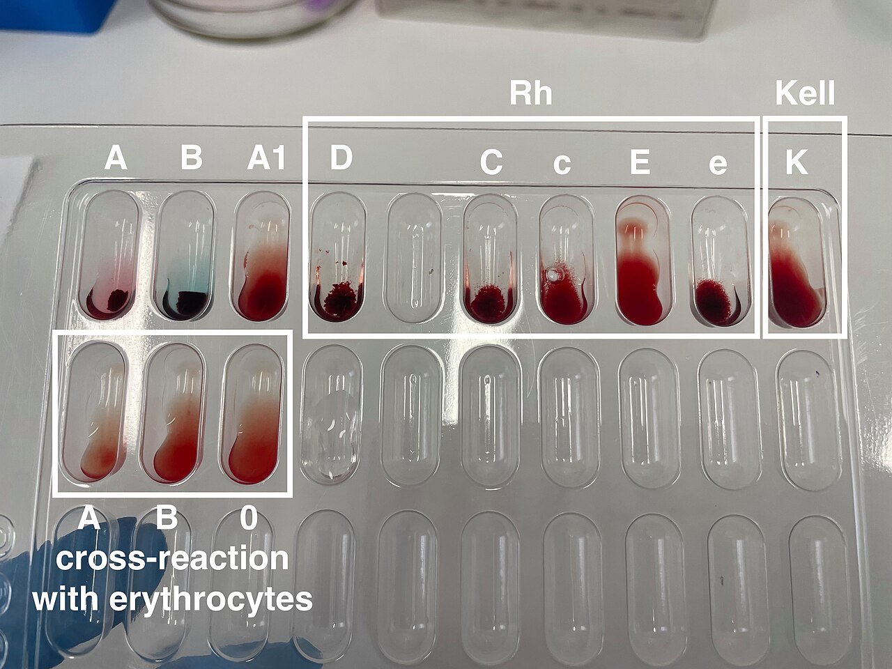 Leki z grupy SGLT2 podnoszą hemoglobinę i hematokryt – wyniki analizy
